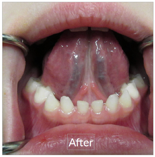 after frenectomy treatment | Collegeville Sleep Well